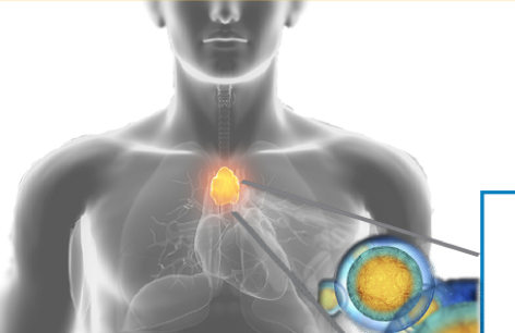 Génial ! Weizmann développe une trithérapie qui vient à bout du cancer du poumon