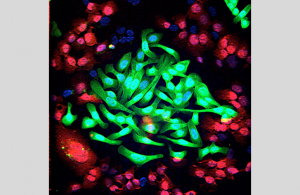Lung cancer cells (green) cultured together with normal lung cells (red). The triple-antibody combination EGFR, HER2 and HER3 strongly impairs the survival of tumor cells while sparing normal cells. Modified confocal microscopy image: Maicol Mancini, lab of Prof. Yosef Yarden
