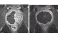 Magnetic resonance images of the prostate gland after treatment with Tookad Soluble. The black regions show the portions of the prostate that have been eliminated to remove the previously detected cancerous tissue