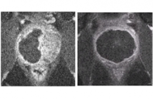 Magnetic resonance images of the prostate gland after treatment with Tookad Soluble. The black regions show the portions of the prostate that have been eliminated to remove the previously detected cancerous tissue